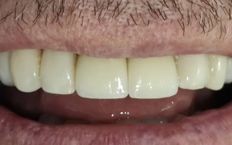 Después: sonrisa natural con implantes
