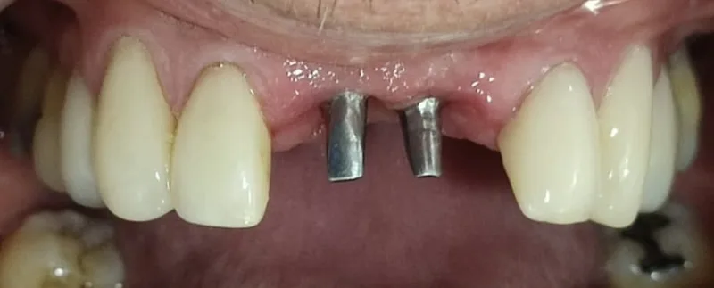 Antes: pilares de implante visibles