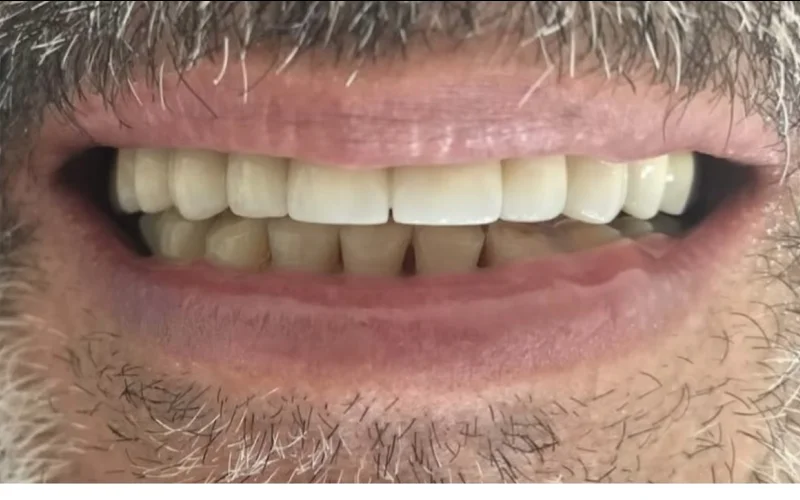 Después: sonrisa completa con prótesis fija