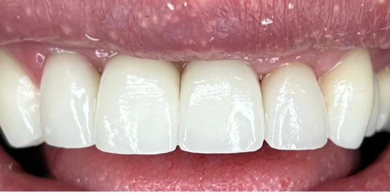 Resultado final — sonrisa restaurada