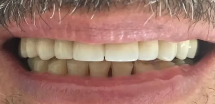 Así quedó: la prótesis fija sobre los implantes, vista con la sonrisa