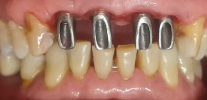 Así llegó: los dientes de adelante con sus bases metálicas a la vista
