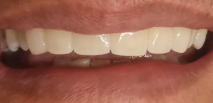 Así quedó: la prótesis fija nueva en los dientes de adelante