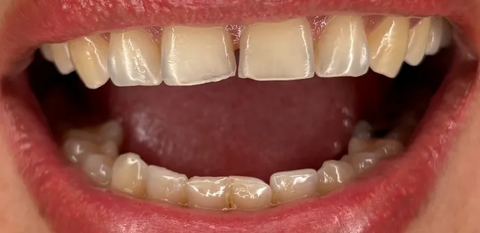 Así llegó: dientes de adelante desgastados y separados