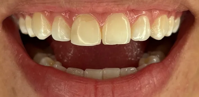 Así llegó: dientes amarillos