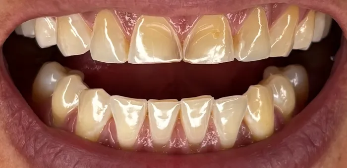Así llegó: dientes desgastados y amarillos arriba y abajo